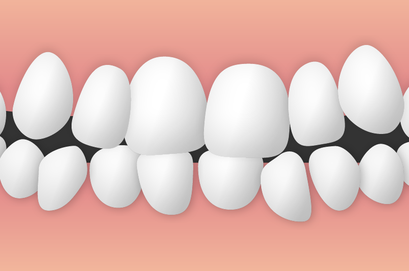 凸凹の歯並びや八重歯